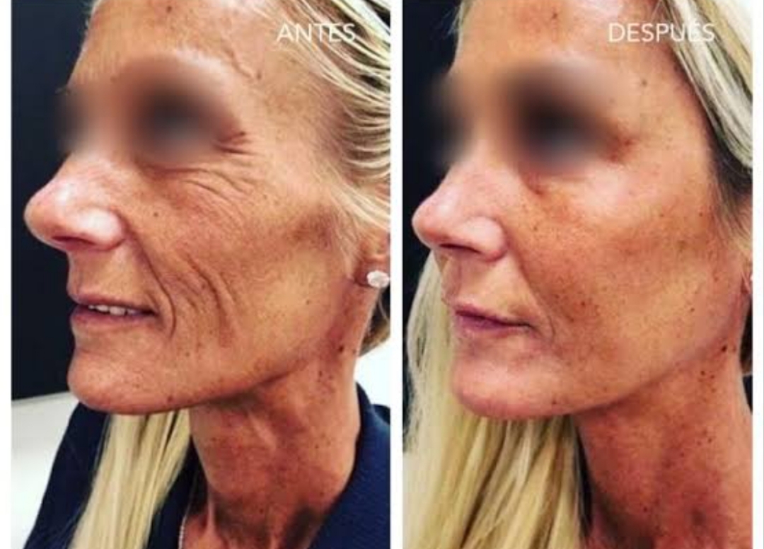 REVOLUCIÓN BIOESTIMULADORA: La Hidroxiapatita de Calcio se consolida como el «estándar de oro» en la medicina estética natural